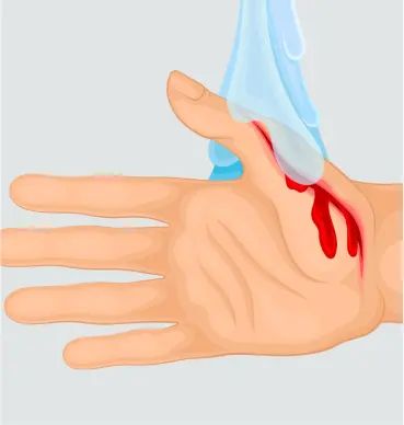 graphic showing water being poured over an open wound from an incision and drainage procedure