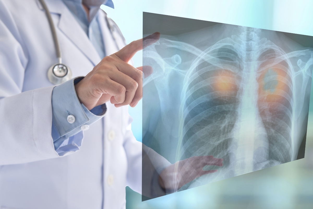 Lung Cancer Screening Orange County