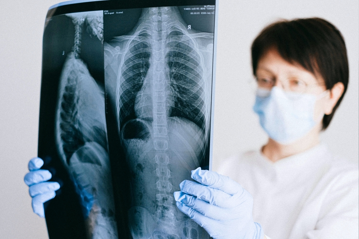 Lung Cancer Screening